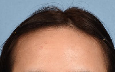 Hair Transplant With NeoGraft Before & After Gallery - Patient 984625 - Image 1