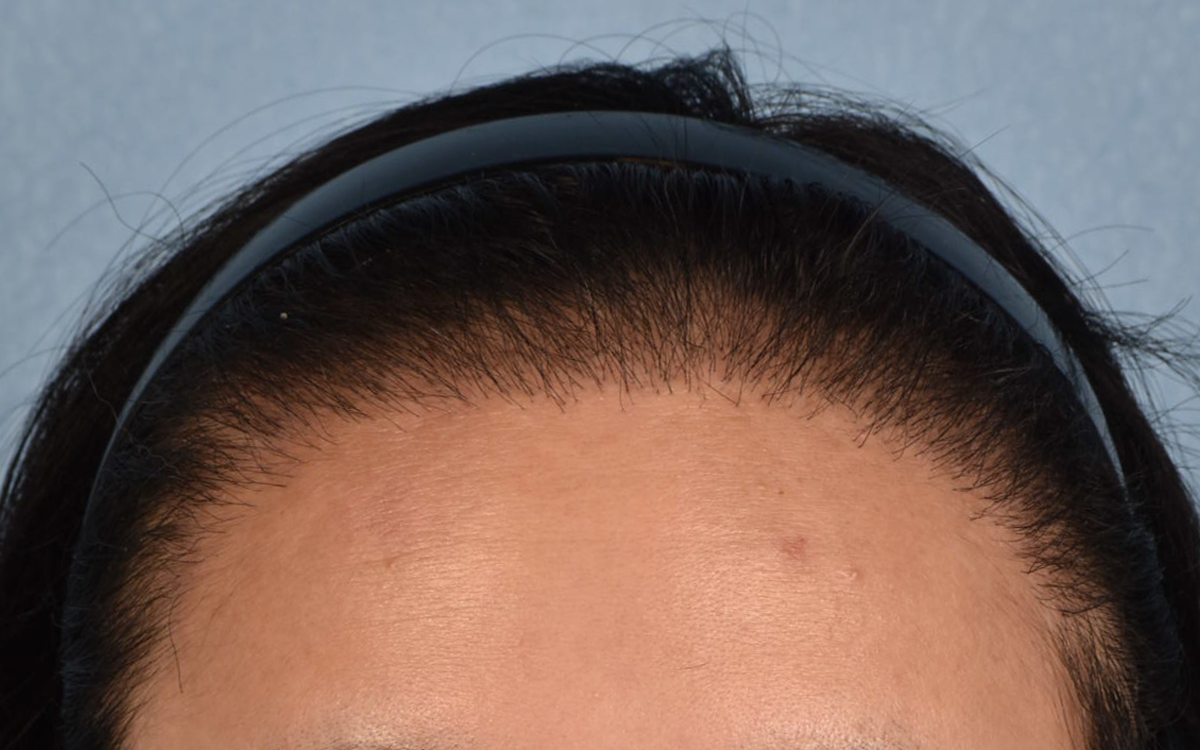 Hair Transplant With NeoGraft Before & After Gallery - Patient 984625 - Image 2