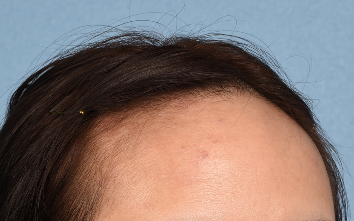 Hair Transplant With NeoGraft Before & After Gallery - Patient 984625 - Image 3