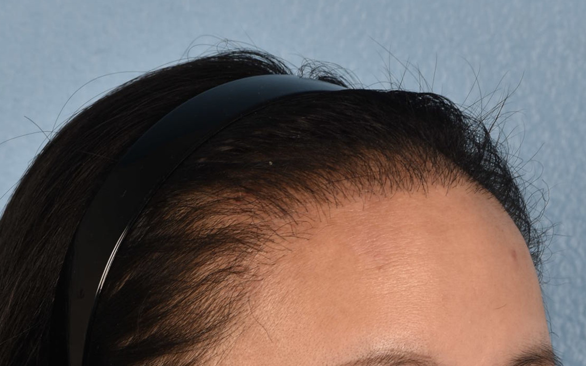 Hair Transplant With NeoGraft Before & After Gallery - Patient 984625 - Image 4