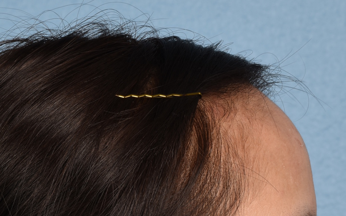 Hair Transplant With NeoGraft Before & After Gallery - Patient 984625 - Image 5