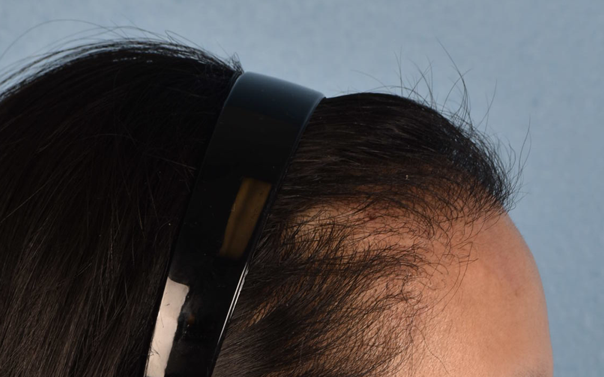 Hair Transplant With NeoGraft Before & After Gallery - Patient 984625 - Image 6