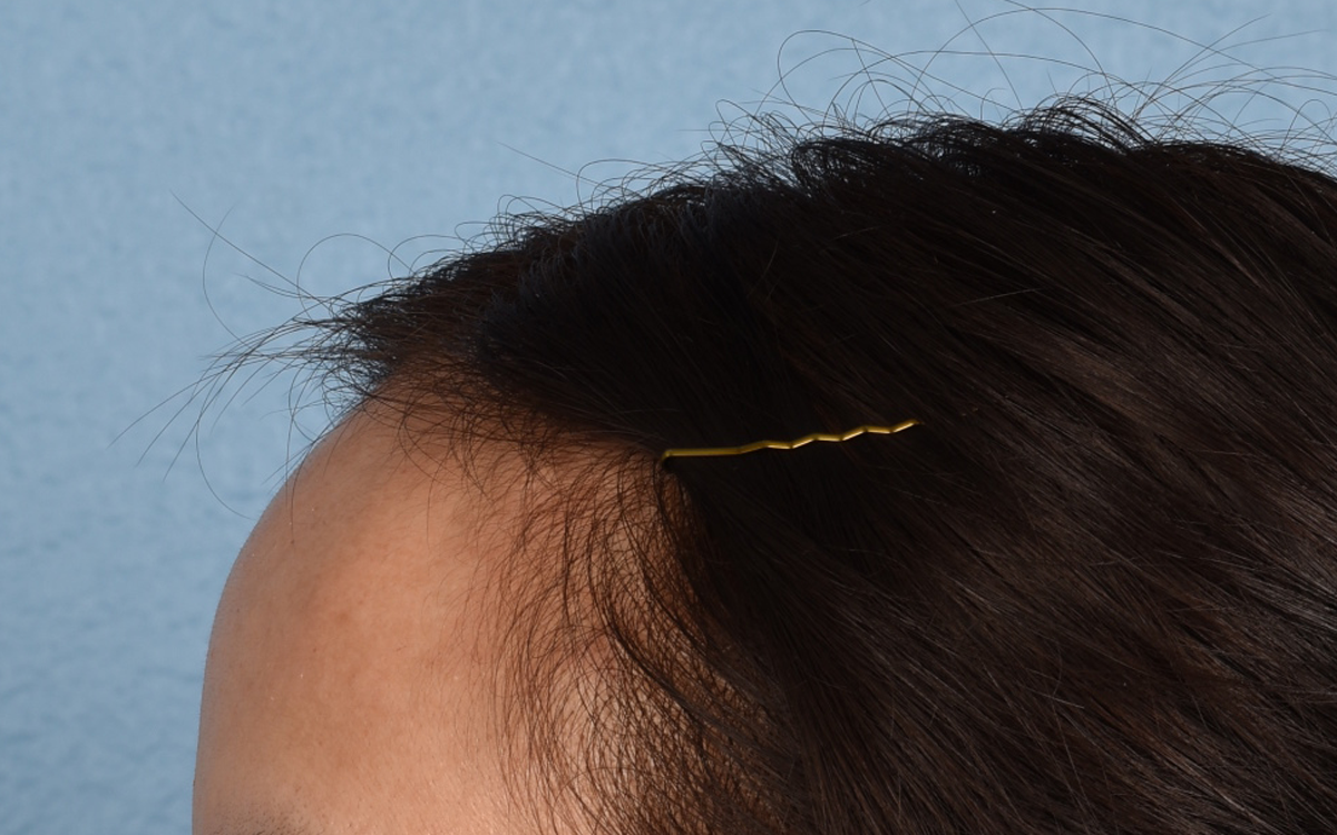 Hair Transplant With NeoGraft Before & After Gallery - Patient 984625 - Image 7
