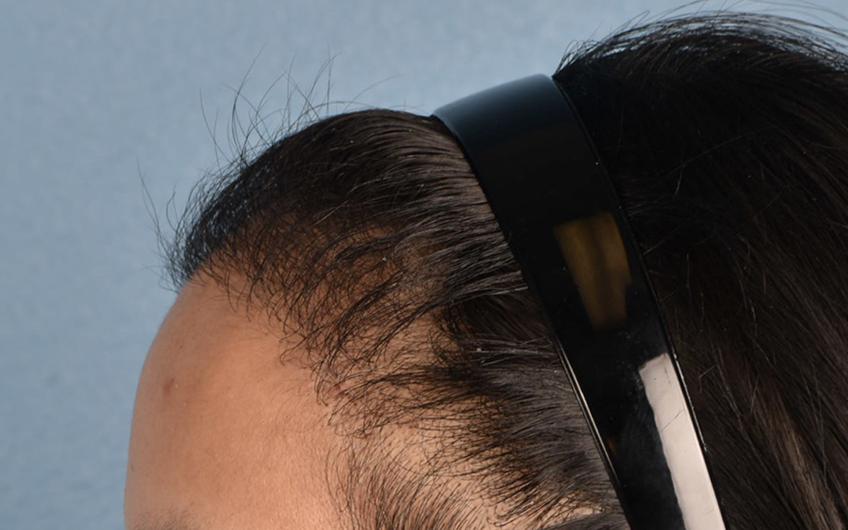 Hair Transplant With NeoGraft Before & After Gallery - Patient 984625 - Image 8