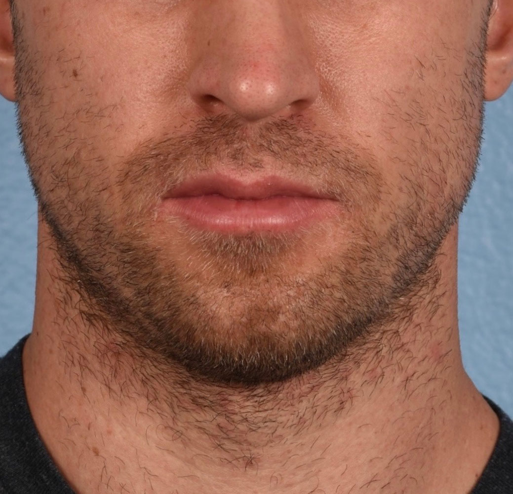 Hair Transplant With NeoGraft Before & After Gallery - Patient 326874 - Image 1