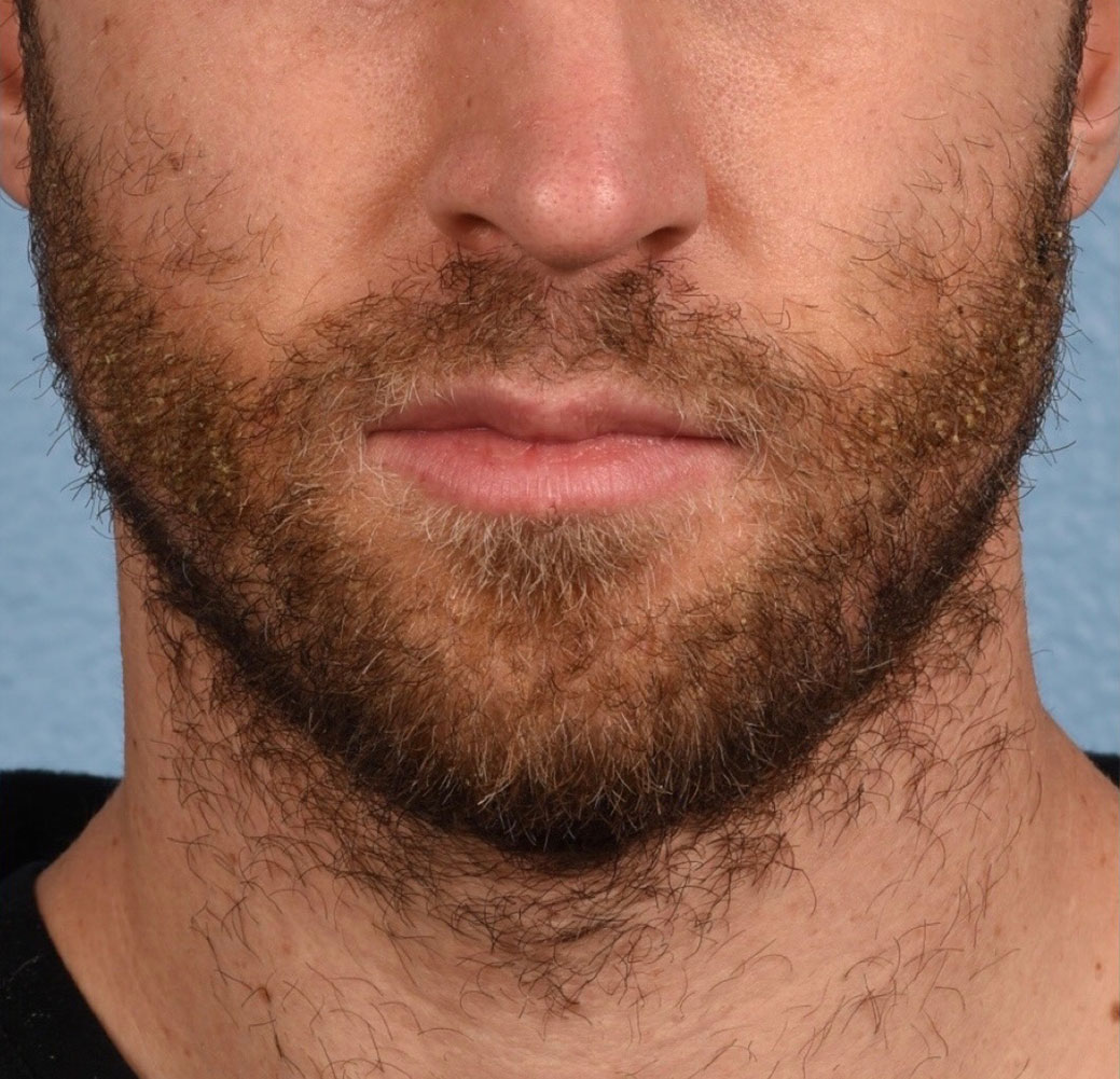 Hair Transplant With NeoGraft Before & After Gallery - Patient 326874 - Image 2