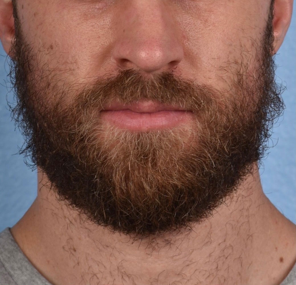 Hair Transplant With NeoGraft Before & After Gallery - Patient 326874 - Image 4