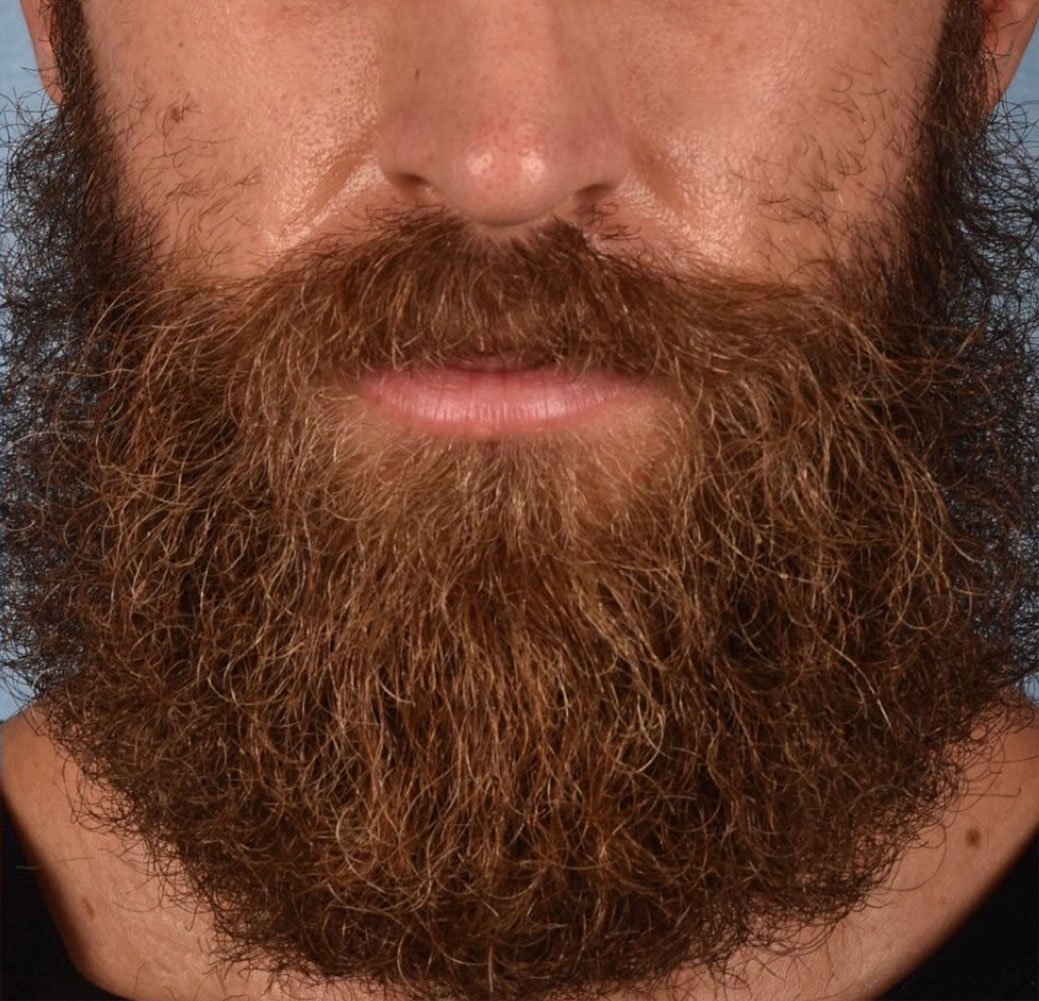 Hair Transplant With NeoGraft Before & After Gallery - Patient 326874 - Image 6