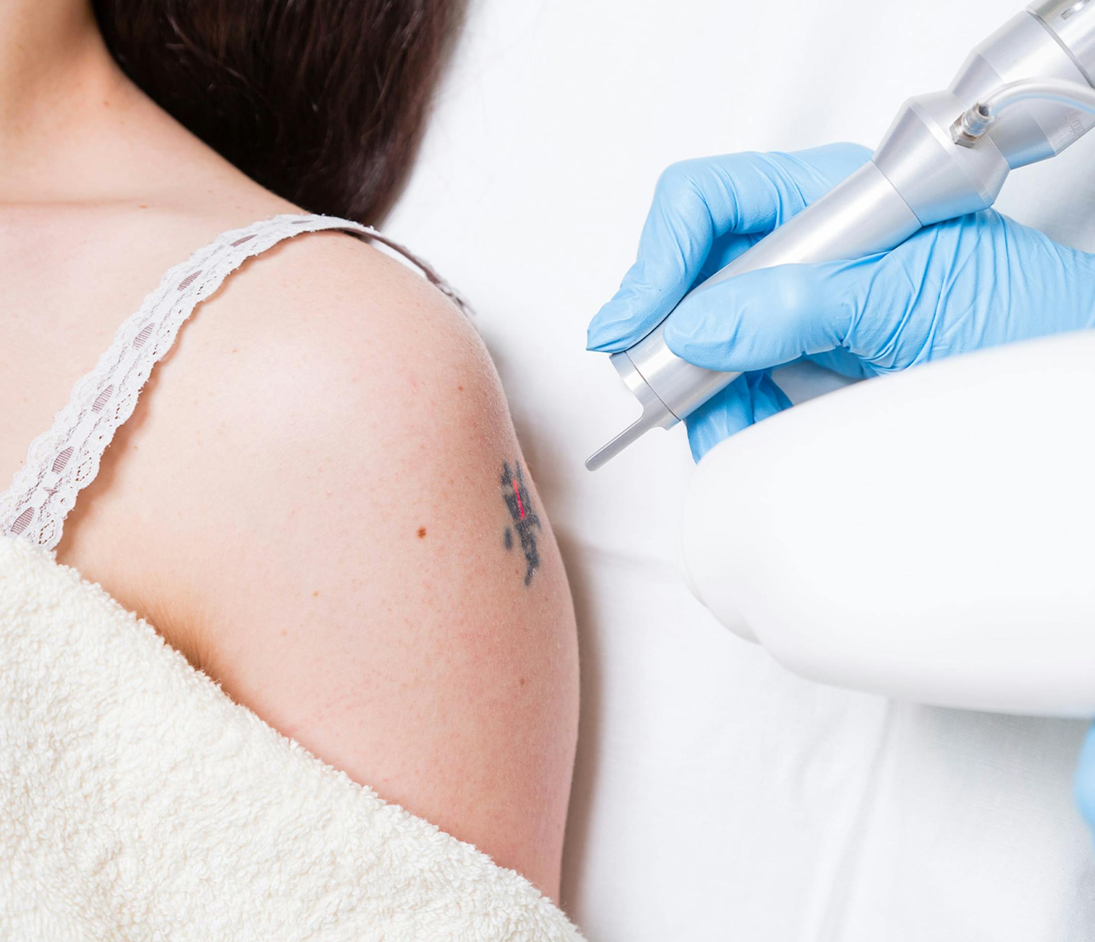 woman receiving tattoo removal
