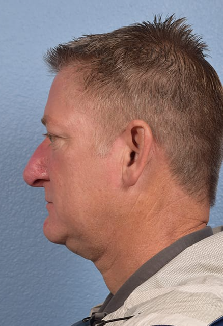 Rhinophyma Before & After Gallery - Patient 169254 - Image 2