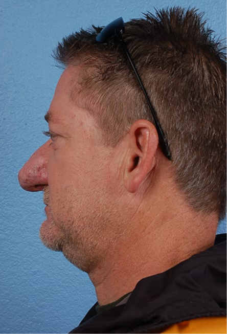 Rhinophyma Before & After Gallery - Patient 169254 - Image 1