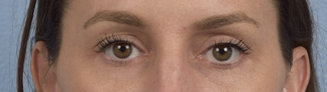 Blepharoplasty Before & After Gallery - Patient 117445 - Image 2