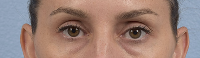 Blepharoplasty Before & After Gallery - Patient 117445 - Image 1