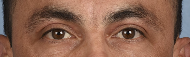 Blepharoplasty Before & After Gallery - Patient 167971 - Image 2