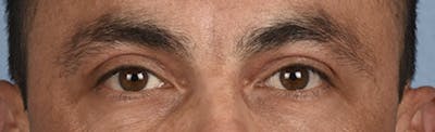 Blepharoplasty Before & After Gallery - Patient 167971 - Image 2