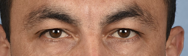 Blepharoplasty Before & After Gallery - Patient 167971 - Image 1