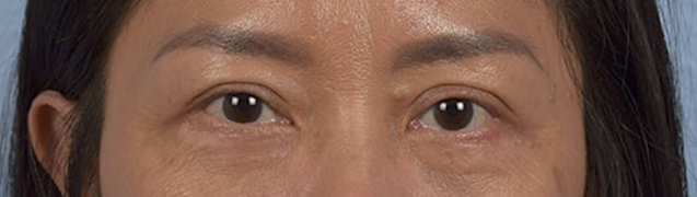 Blepharoplasty Before & After Gallery - Patient 284163 - Image 2