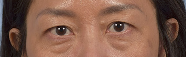 Blepharoplasty Before & After Gallery - Patient 284163 - Image 1