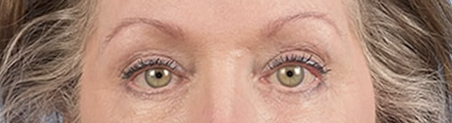 Blepharoplasty Before & After Gallery - Patient 362822 - Image 2