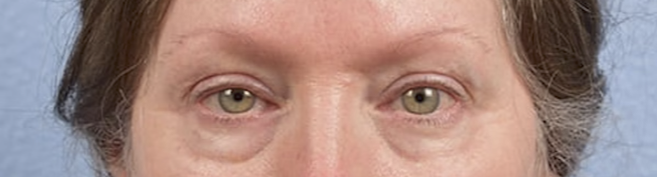 Blepharoplasty Before & After Gallery - Patient 362822 - Image 1