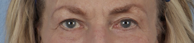 Blepharoplasty Before & After Gallery - Patient 912260 - Image 2
