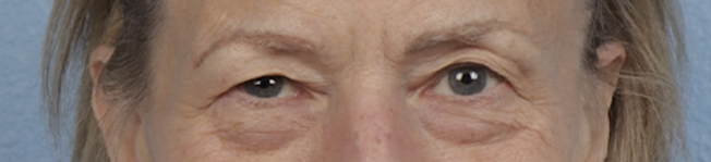 Blepharoplasty Before & After Gallery - Patient 912260 - Image 1