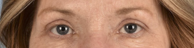 Blepharoplasty Before & After Gallery - Patient 943759 - Image 2