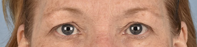 Blepharoplasty Before & After Gallery - Patient 943759 - Image 1