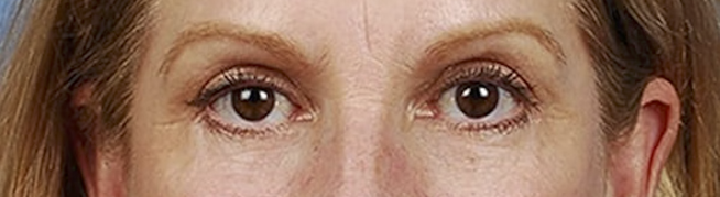Blepharoplasty Before & After Gallery - Patient 177584 - Image 2