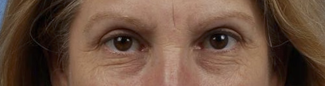 Blepharoplasty Before & After Gallery - Patient 177584 - Image 1