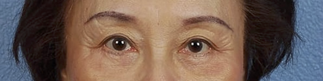 Blepharoplasty Before & After Gallery - Patient 181630 - Image 2