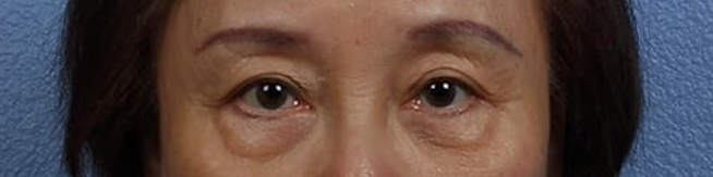 Blepharoplasty Before & After Gallery - Patient 181630 - Image 1