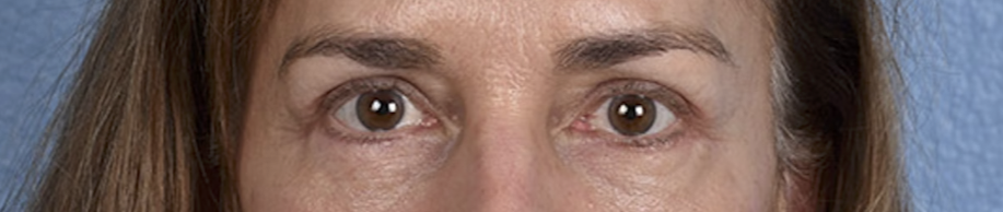 Blepharoplasty Before & After Gallery - Patient 195497 - Image 2