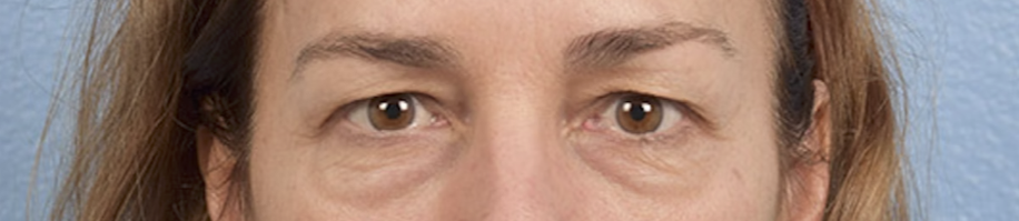 Blepharoplasty Before & After Gallery - Patient 195497 - Image 1