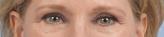 Blepharoplasty Before & After Gallery - Patient 216006 - Image 2