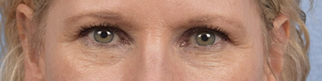 Blepharoplasty Before & After Gallery - Patient 216006 - Image 1
