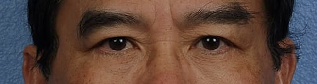 Blepharoplasty Before & After Gallery - Patient 232957 - Image 2