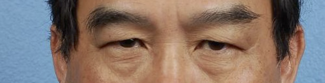 Blepharoplasty Before & After Gallery - Patient 232957 - Image 1