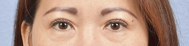 Blepharoplasty Before & After Gallery - Patient 252264 - Image 2