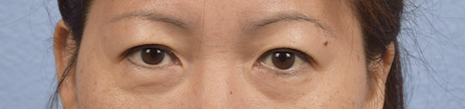 Blepharoplasty Before & After Gallery - Patient 252264 - Image 1