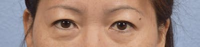 Blepharoplasty Before & After Gallery - Patient 252264 - Image 1