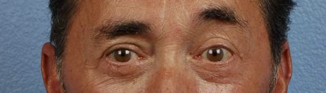 Blepharoplasty Before & After Gallery - Patient 289939 - Image 2