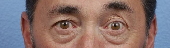 Blepharoplasty Before & After Gallery - Patient 289939 - Image 1
