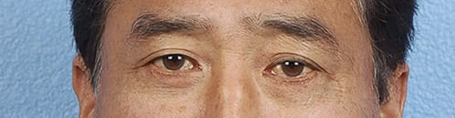 Blepharoplasty Before & After Gallery - Patient 481320 - Image 2