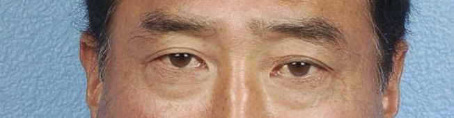Blepharoplasty Before & After Gallery - Patient 481320 - Image 1