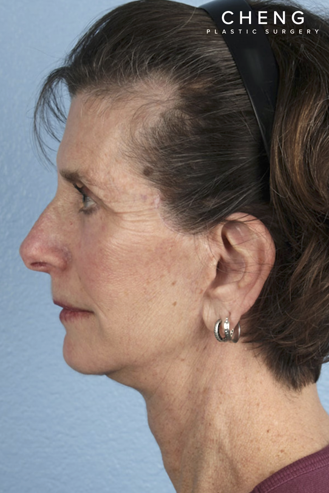 Facelift Before & After Gallery - Patient 307064 - Image 2