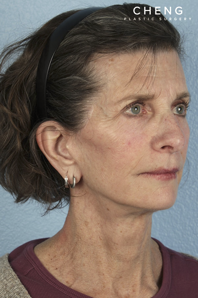 Facelift Before & After Gallery - Patient 307064 - Image 4