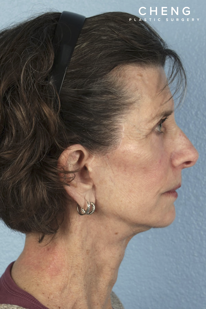 Facelift Before & After Gallery - Patient 307064 - Image 6