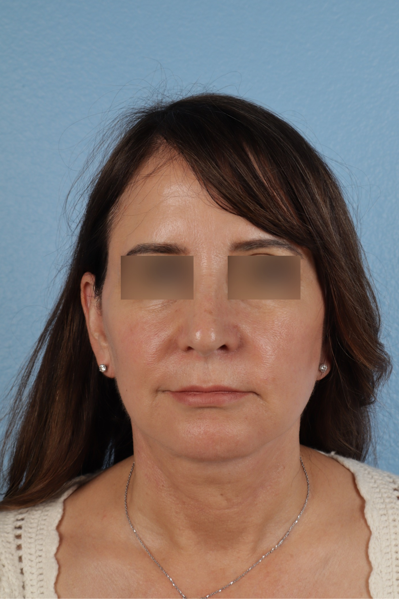 Facelift Before & After Gallery - Patient 407291 - Image 2