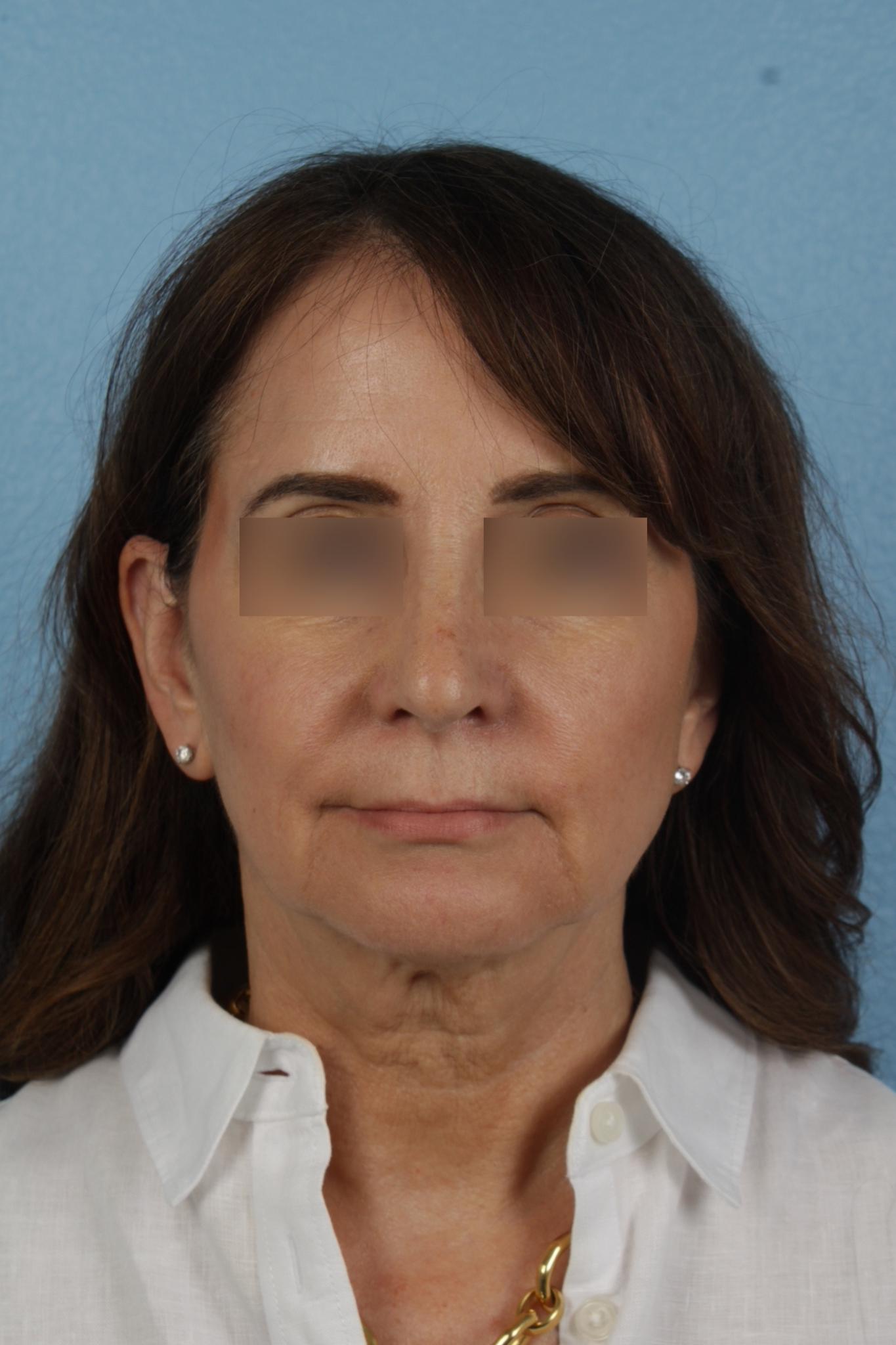 Facelift Before & After Gallery - Patient 407291 - Image 1